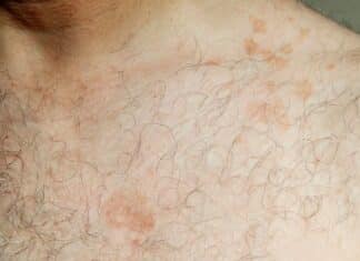 Les principales causes des tâches jaunes sur la peau et comment les traiter