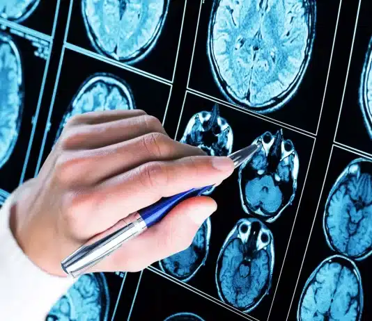 Quels sont les effets de la dégénérescence cérébrale sur la vie quotidienne ?