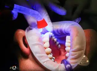 Facette dentaire : les différents problèmes dentaires pouvant être traités