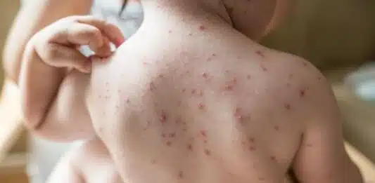 Quand la scarlatine n’est-elle plus contagieuse?